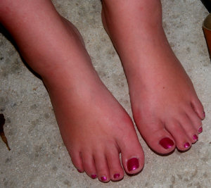 swollen_feet.jpg